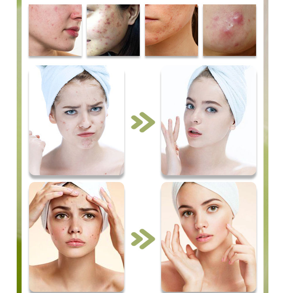 Kstims Natuurlijke Acne Behand - Tea Tree Spot Treatment recensie en prijs